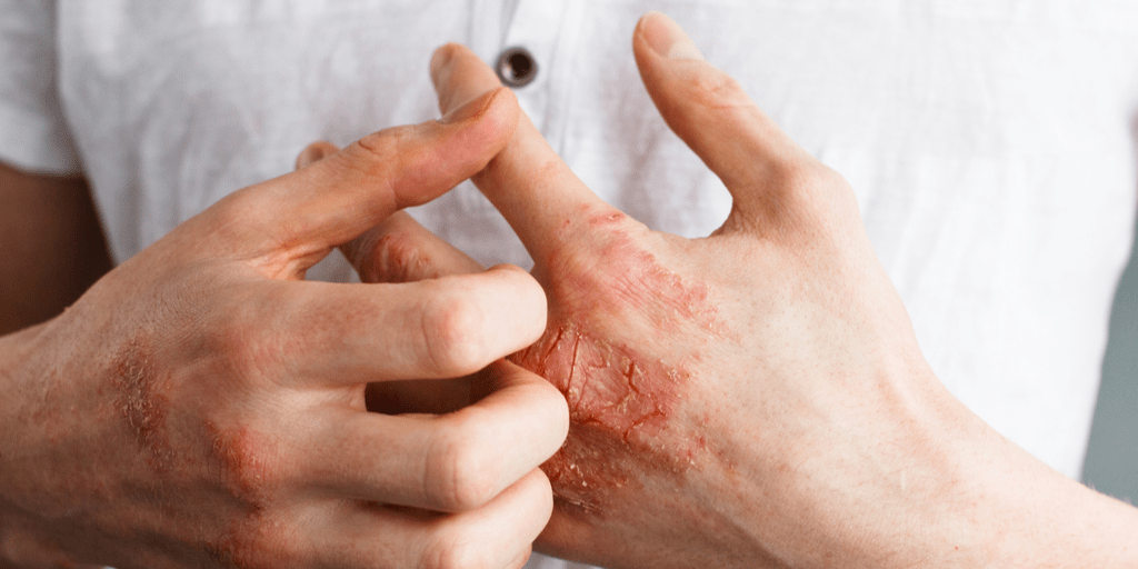 Eczema Symptoms, Causes & Treatment Affiliated Dermatology