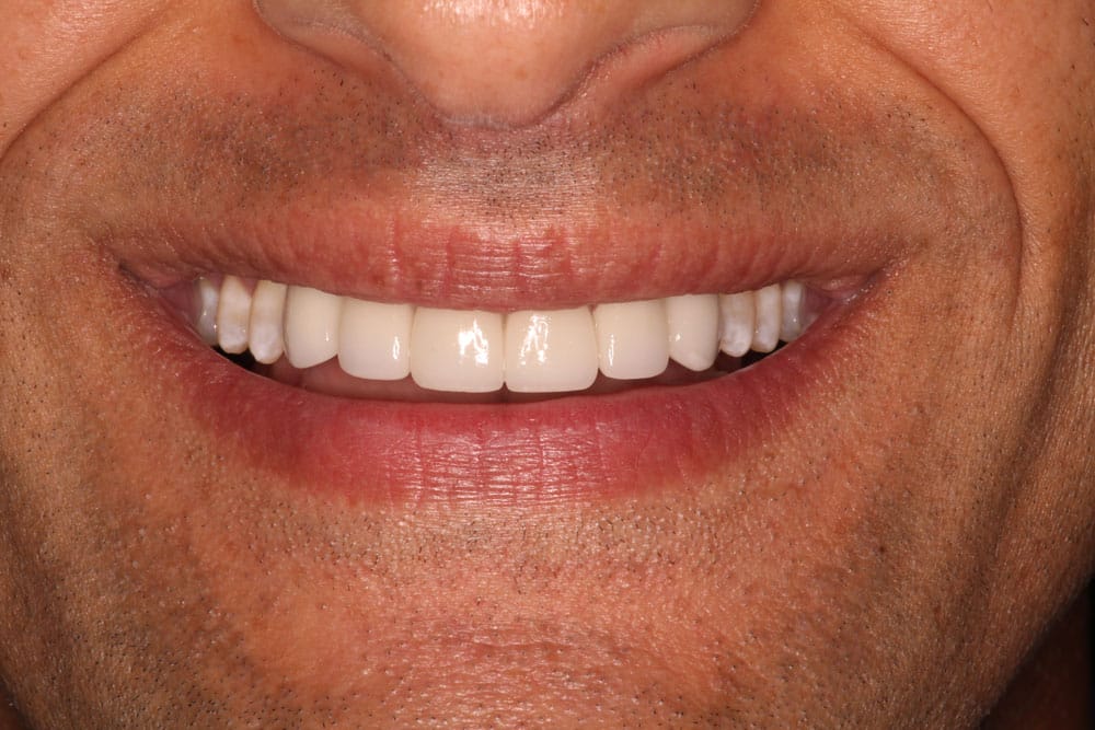 Before & After Dental Treatment Photos Affinity Dental Chicago, IL