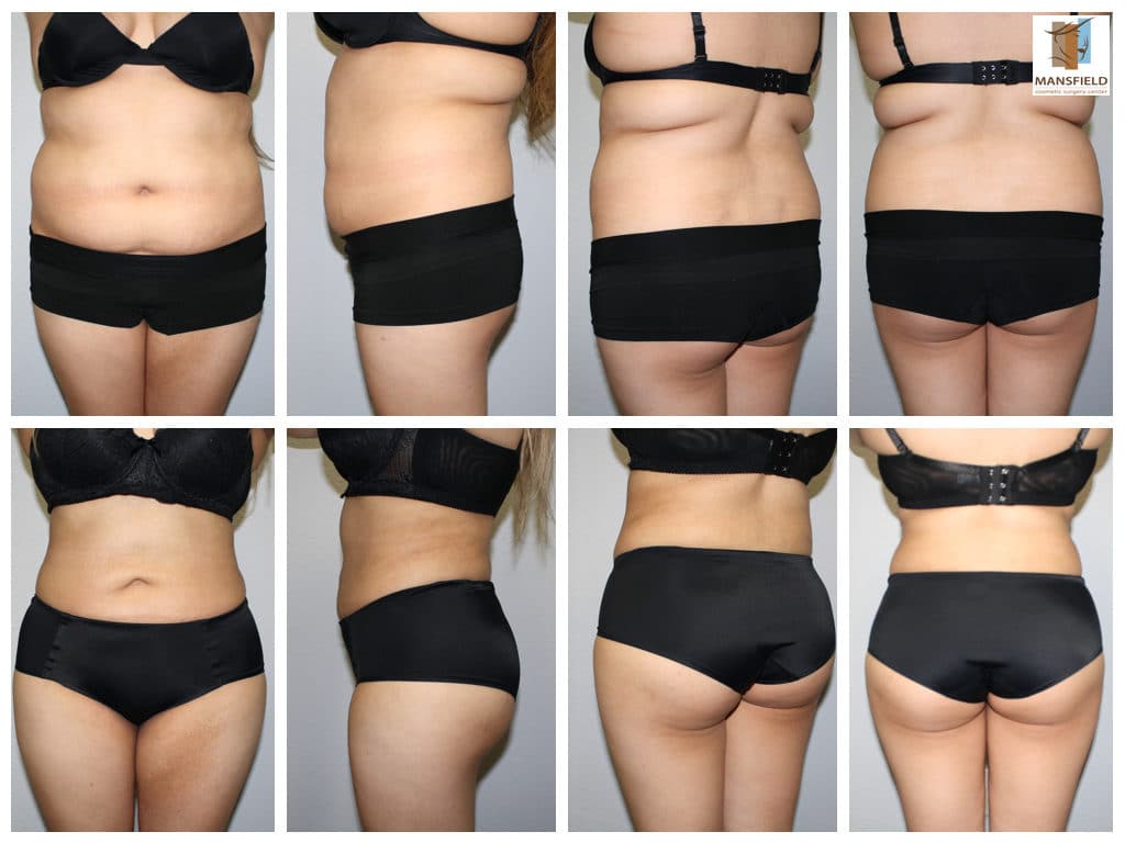 Brazilian butt lift Surgery Cost in Lagos Find the Best Surgeons