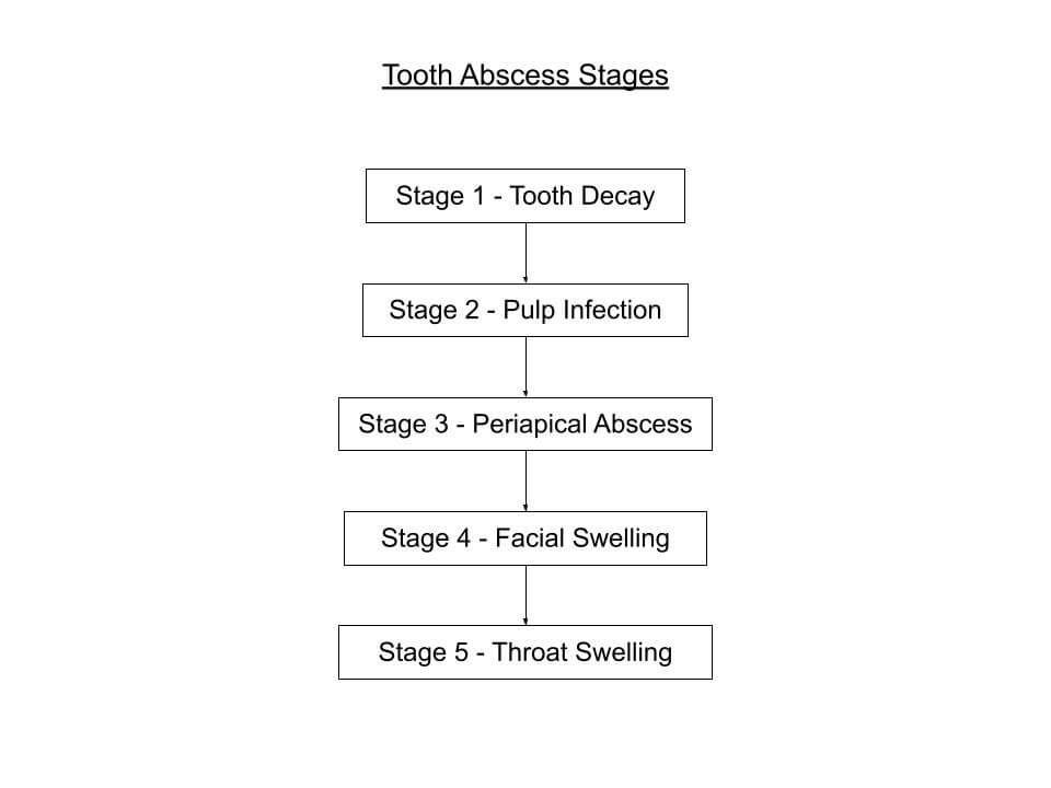 Tooth Infection Lethality How Much Time Do I Have? afterva Oral