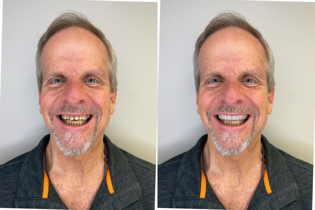 Digital Smile Design Take Your Smile to the Next Level Afton Dental in Concord, NC