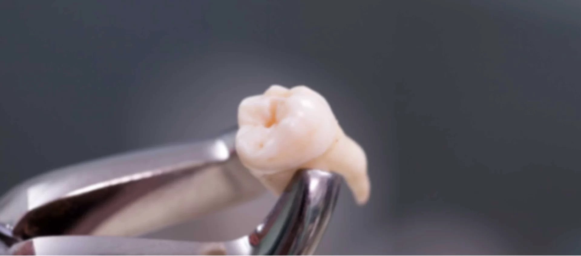 Root Canals Aesthetic General Dentistry of Frisco