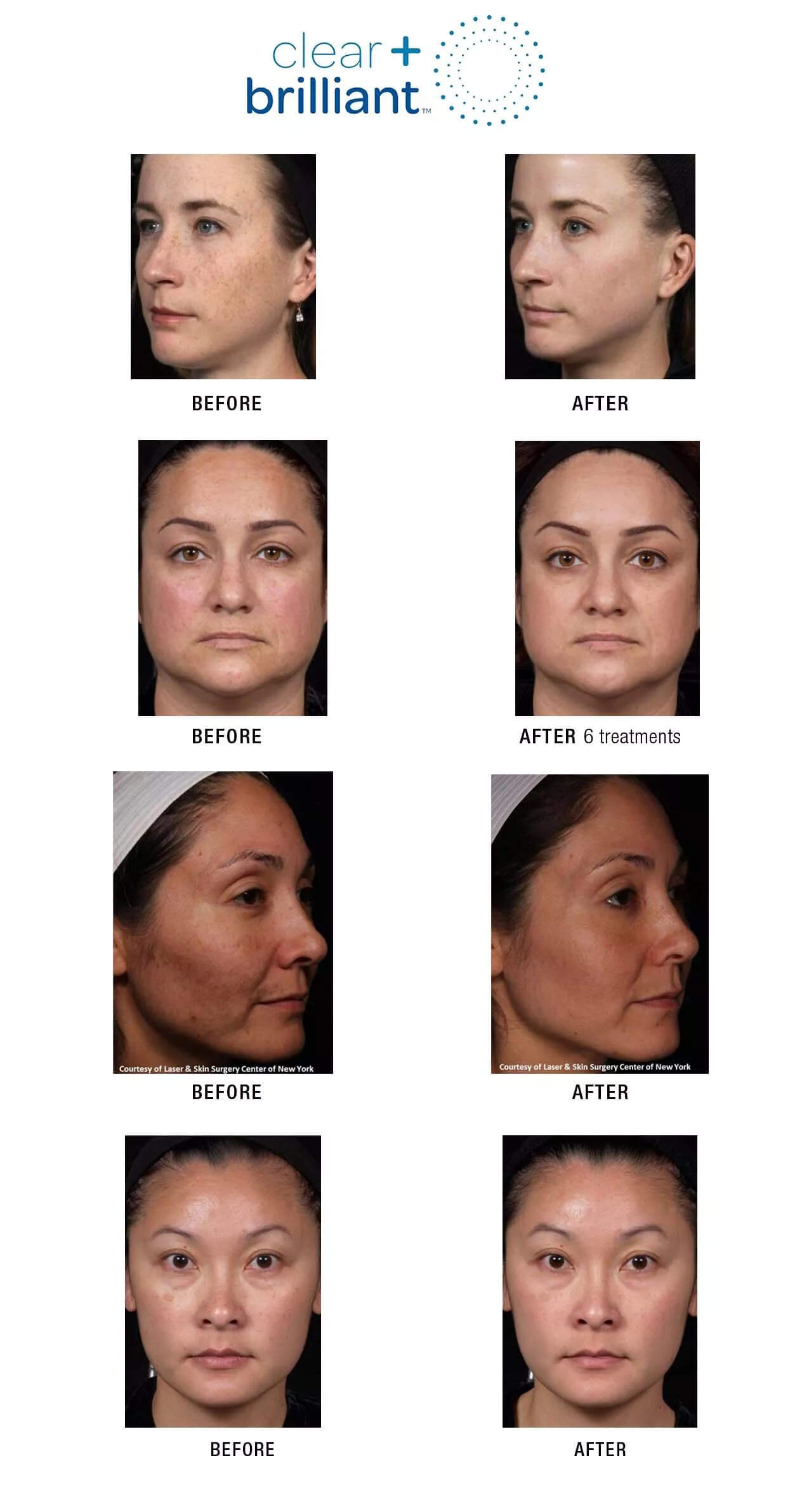 Skin Rejuvenation and Resurfacing Laser Genesis Age Perfectly
