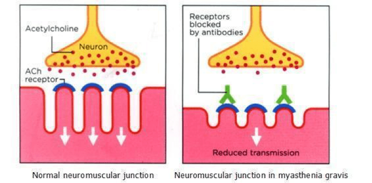 What is Myasthenia Gravis? The Aggie Transcript