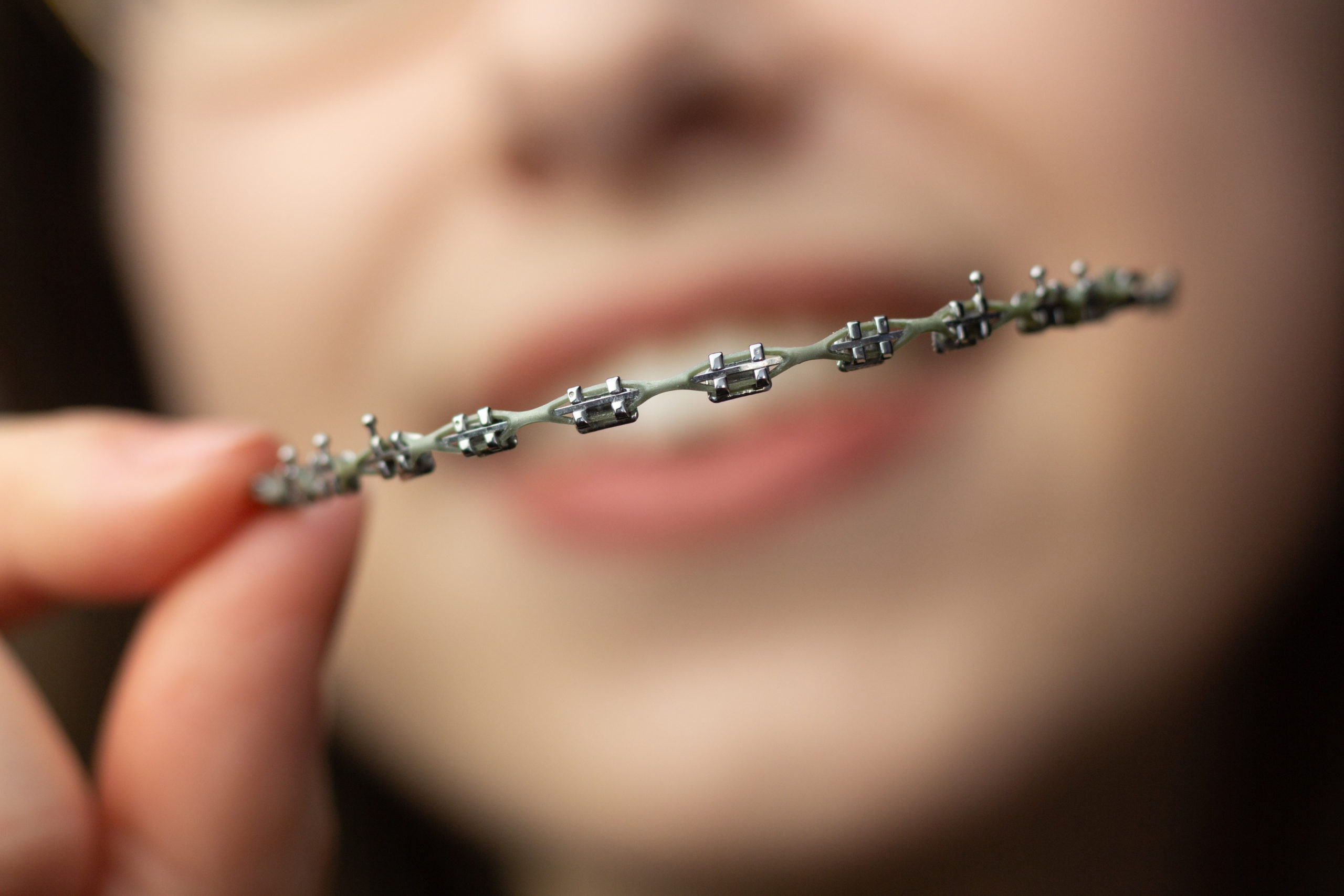 The Bands On My Braces Keep Falling Off at Diana Smith blog