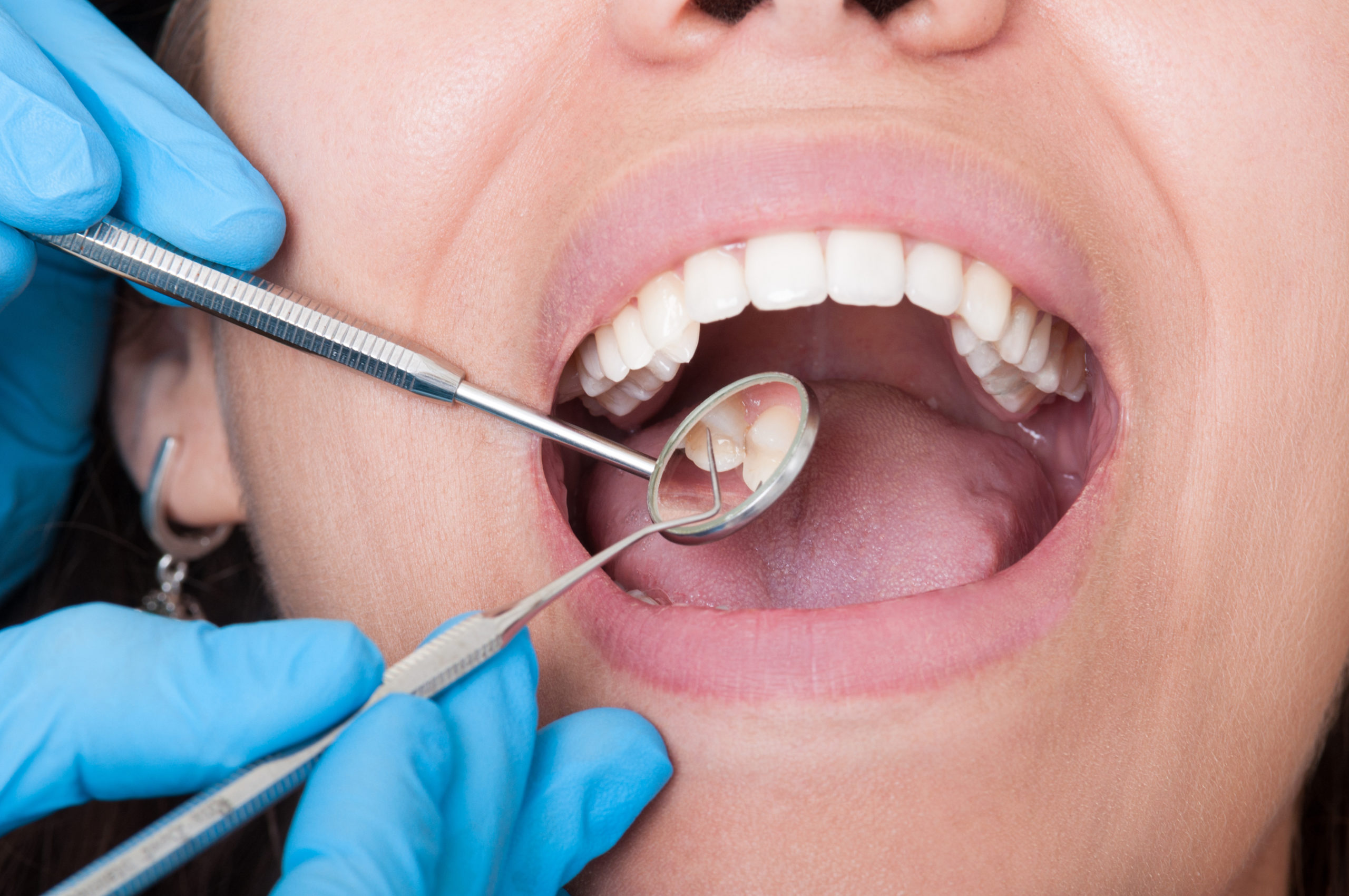 How Common Are Cavities After Braces? Ahava Orthodontics