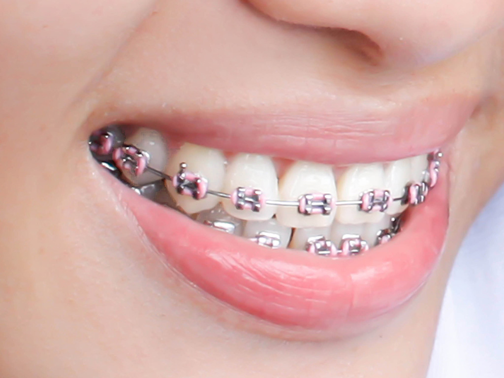 Types Of Braces