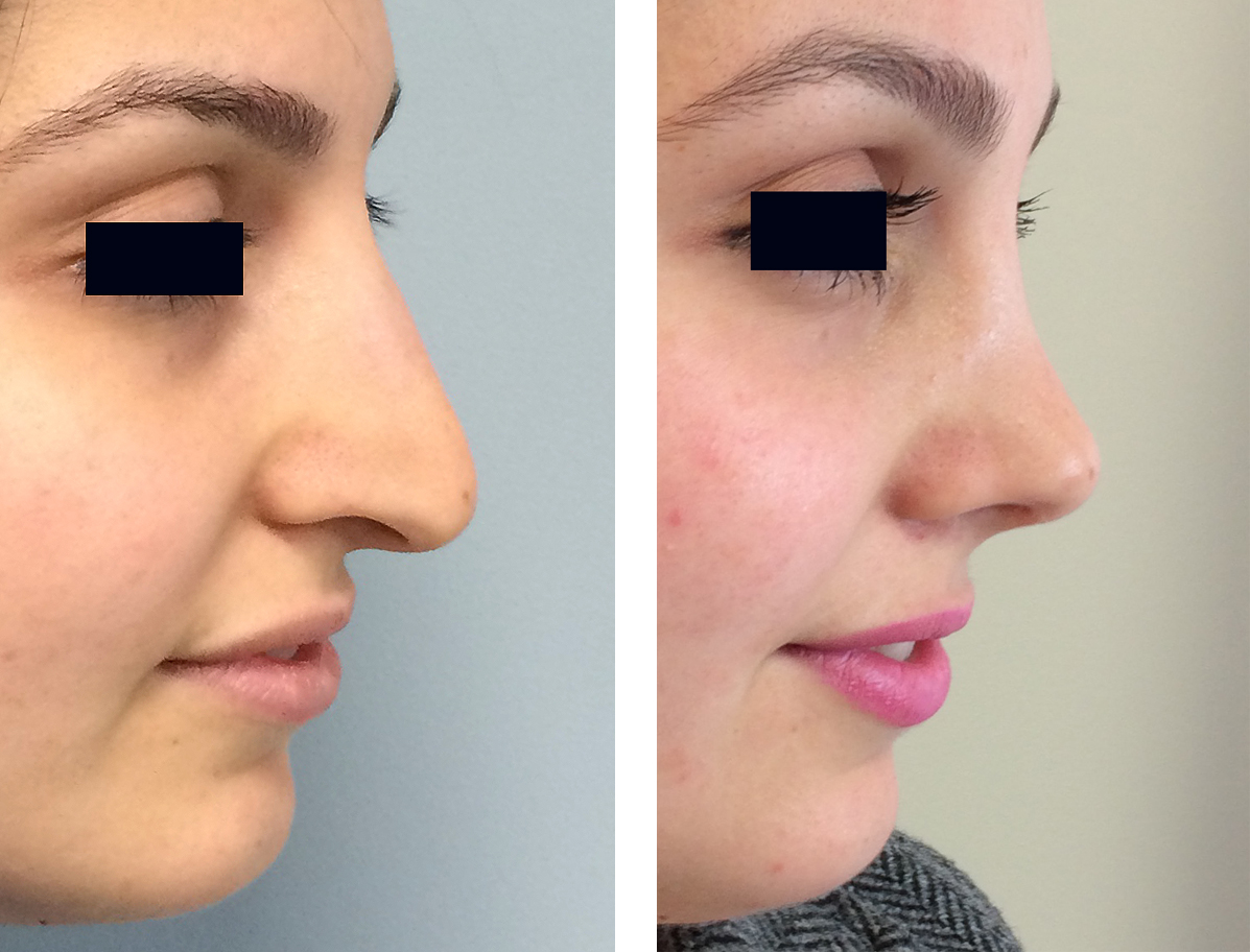 Plastic surgery before & after photos Rhinoplasty Surgery