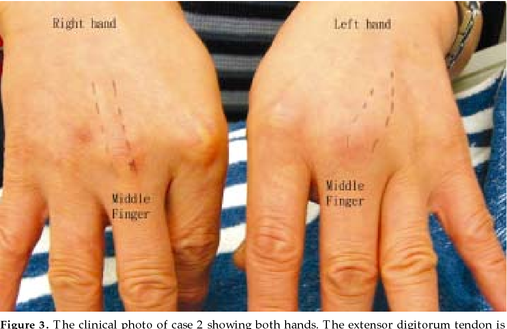 Figure 3 from Boxer ' s knuckle of nonboxer patients Semantic Scholar