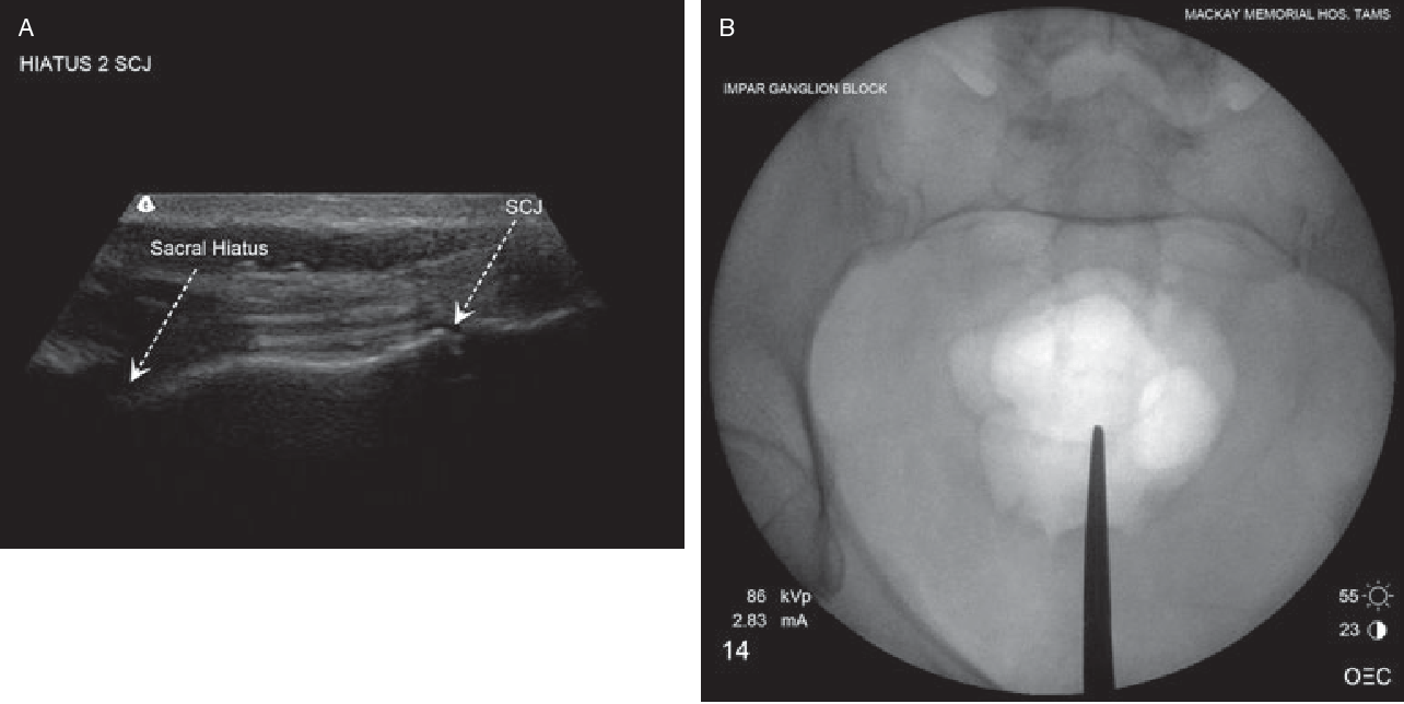 Figure 3 from Ultrasoundguided ganglion impar block a technical report. Semantic Scholar