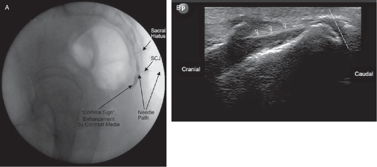 Figure 4 from Ultrasoundguided ganglion impar block a technical report. Semantic Scholar