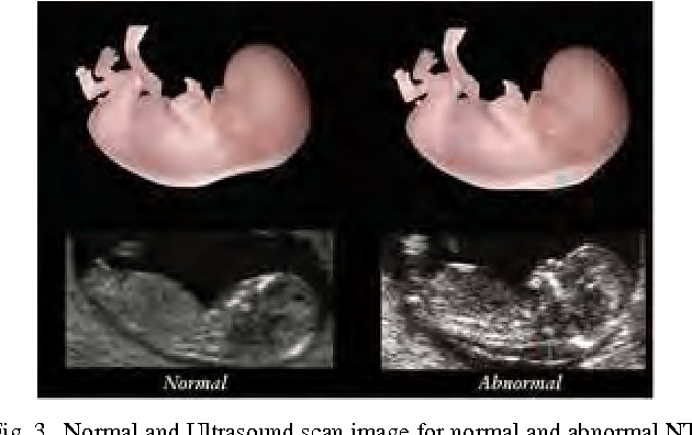 Figure 3 from Ultrasound Image Classification for Down Syndrome During