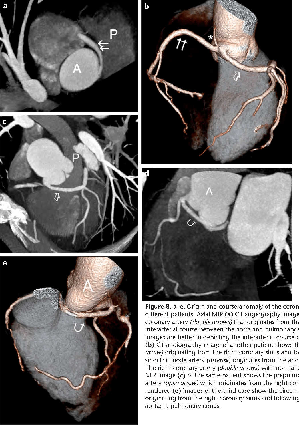 64 Slice Ct Angiography Heart Scan Malaysia ct scan machine
