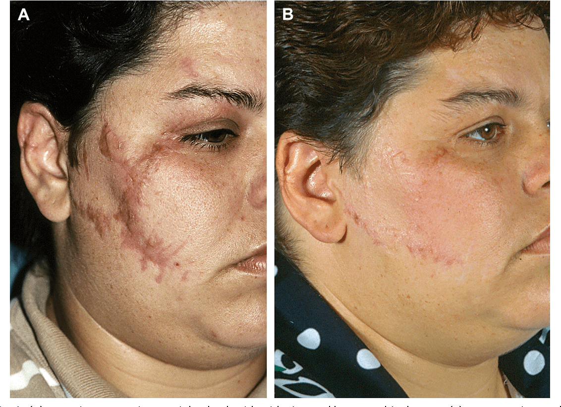 Figure 6 from Scar revision techniques zplasty, wplasty, and