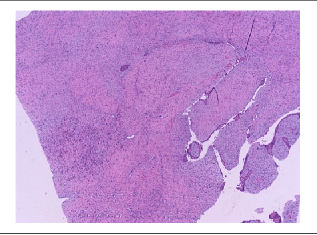 Ameloblastic Fibroma Pathology Outlines AMELOBLASTIC CARCINOMA PDF