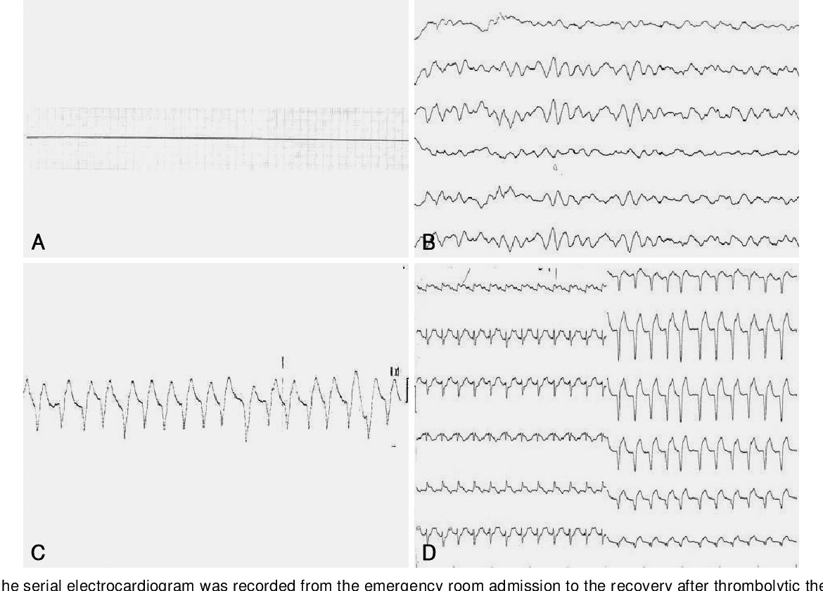 Figure 1 from Thrombolytic Therapy during Cardiopulmonary Resuscitation