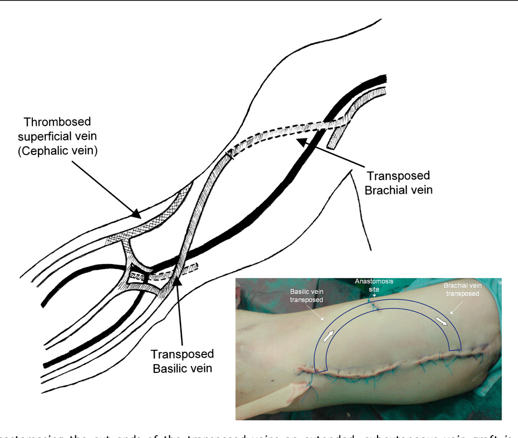 BASILIC VEIN TRANSPOSITION PDF