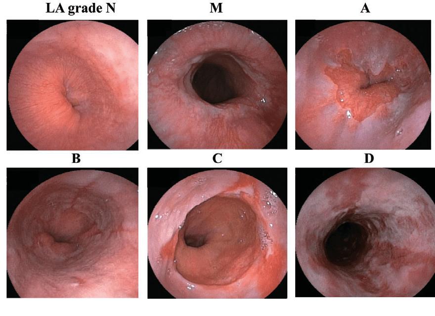 Figure 1 from Unsedated transnasal ultrathin esophagogastroduodenoscopy