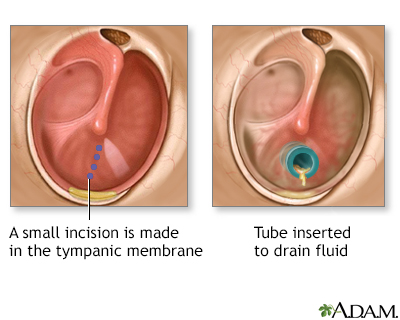 Ear Infection Chronic A D A M Interactive Anatomy Encyclopedia