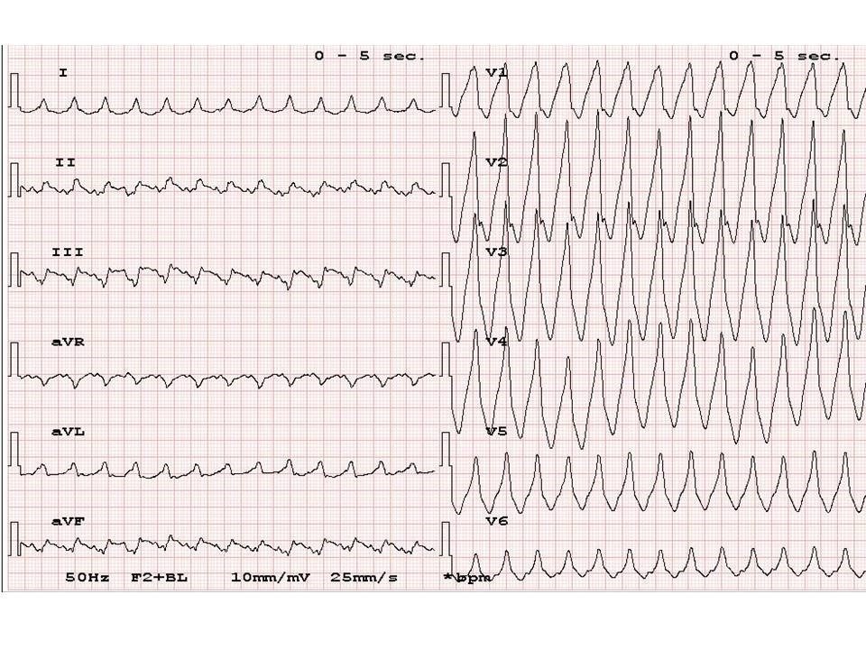 Tachicardia a QRS largo in paziente con cardiopatia infartuale AIAC