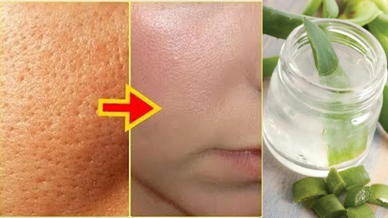 Home Remedies All Open Pores Will Disappear From Your Skin Forever!
