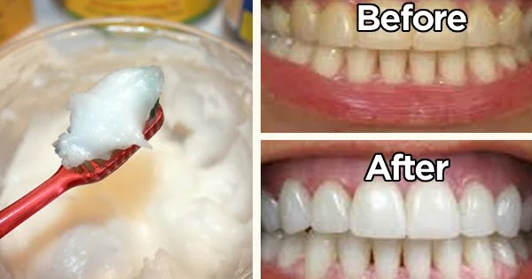 How to Use Baking Soda Correctly to Whiten Your Teeth In Just 5 Days