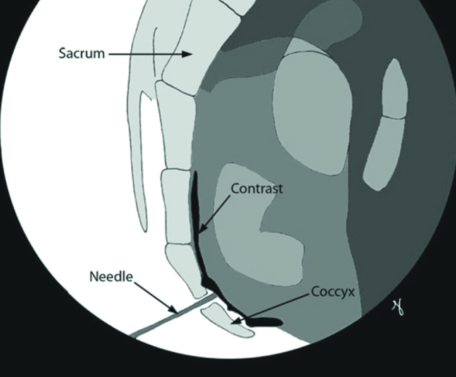 Cpt Code For Coccyx Injection 2019 cptcode.se