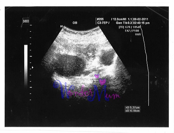 Doa Kecutkan Cyst Sebesar 5cm Ainul Mustafa