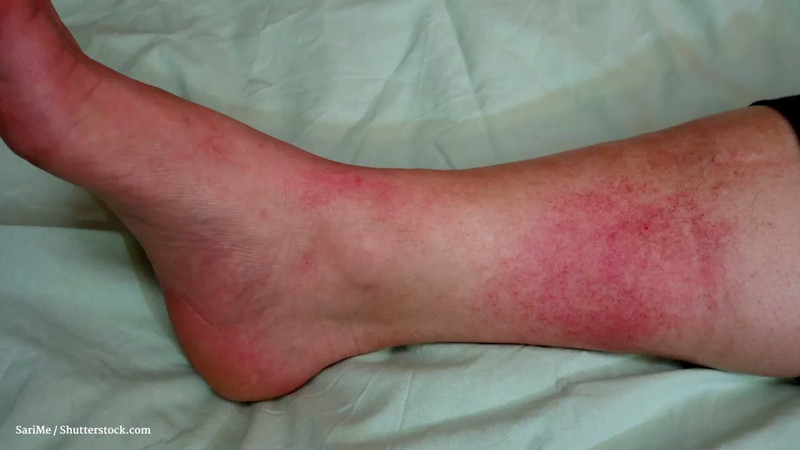 Gesundheitslexikon Erysipel (Wundrose)
