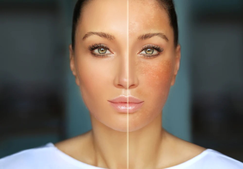Uneven Skin Tone Understanding its Causes & Treatment