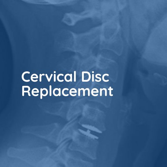 Cervical Disc Replacement