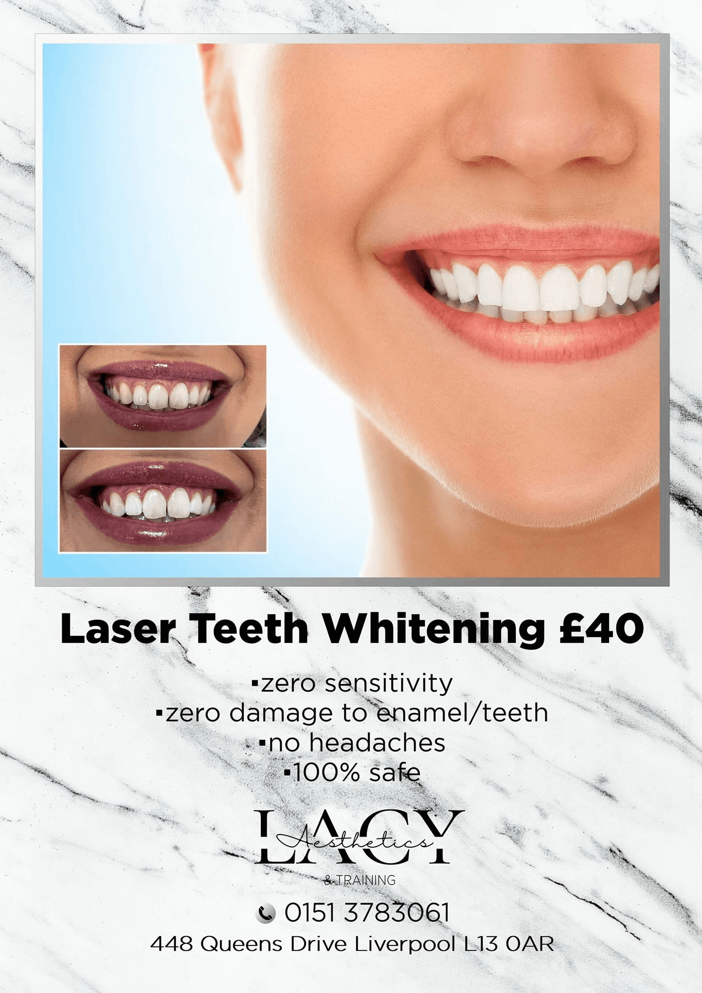 Laser teeth whitening A Lacy Aesthetics Training