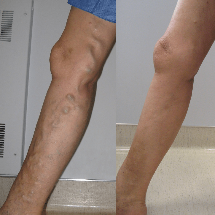 Varicose Vein Pictures Alaska Vein Clinic