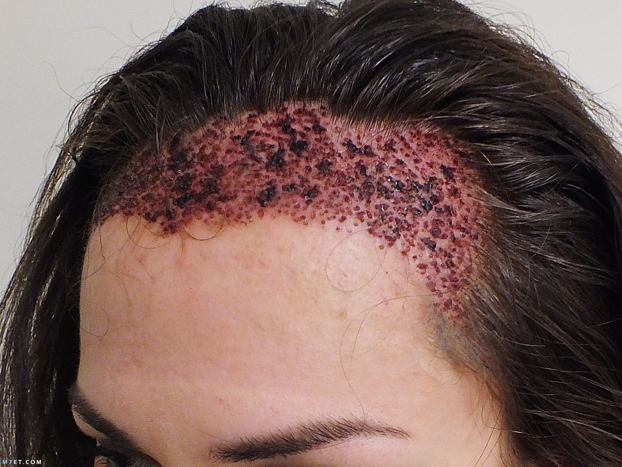 افضل دكتور زراعة شعر في تركيا