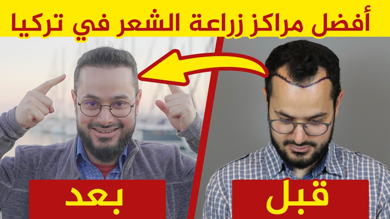 افضل دكتور زراعة شعر في تركيا