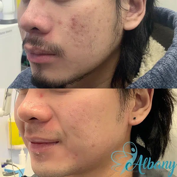 Icepick Scar Treatments In Edmonton at Albany Laser Centre