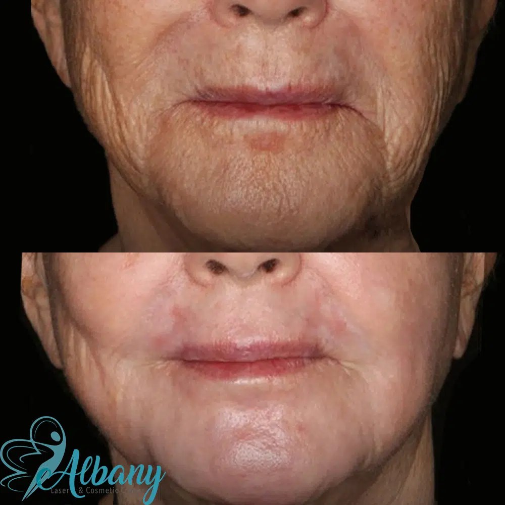 Age spot treatment In Edmonton Age spot treatment in St. Albert