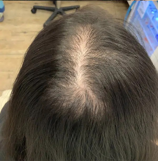 Hair Loss Treatment in Edmonton and St. Albert Edmonton Cost, Results