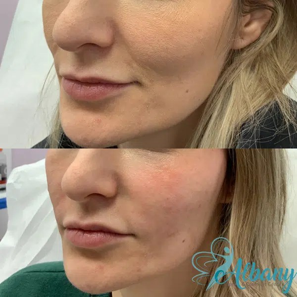 PlateletRich Fibrin Benefit, Cost, Procedure, Results, Side effects