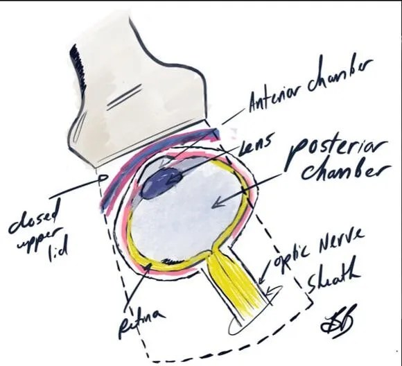 Optic nerve sheath diameter Alberta Sono