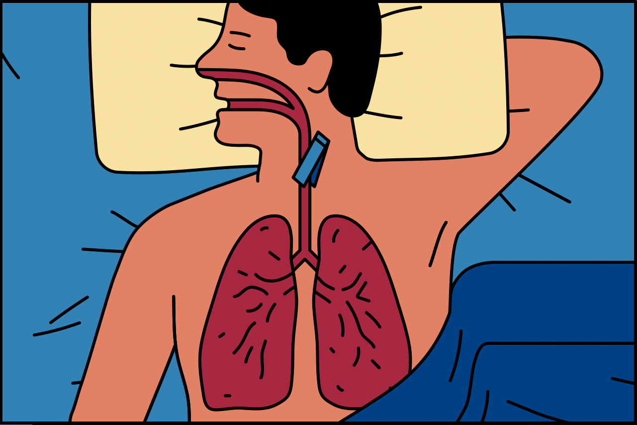 Albert Tercero — The New York Times A Guide to Sleep Apnea