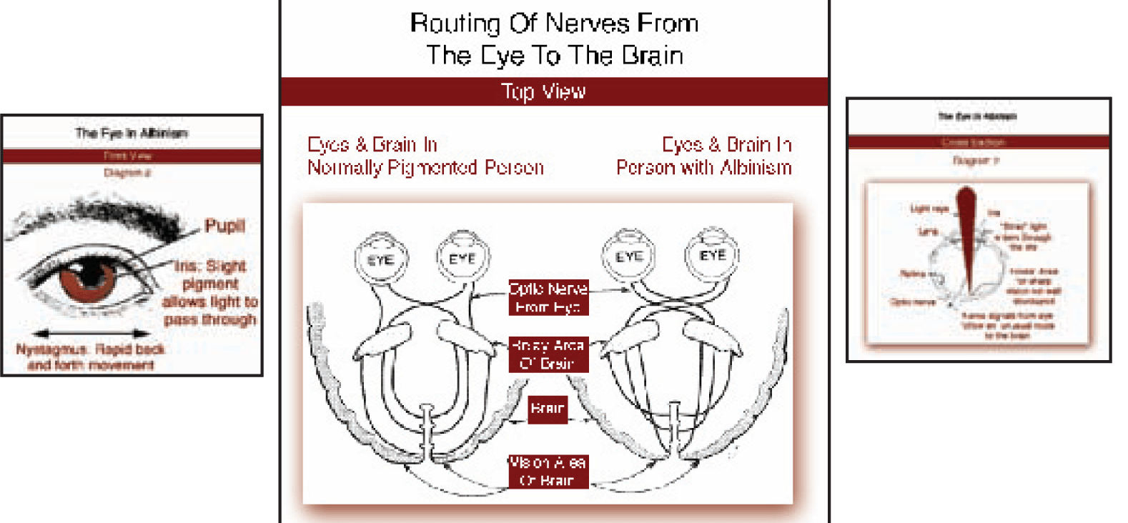 Low Vision The Albinism Alliance Group