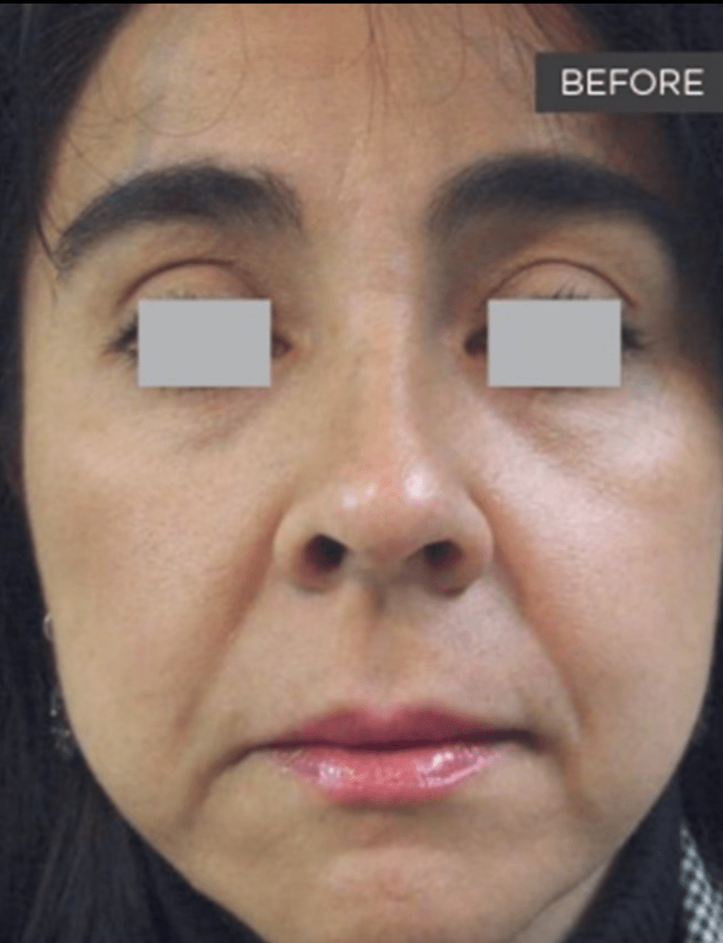 Fotona 4D NonSurgical Face Lift in Ottawa alchemistlaser