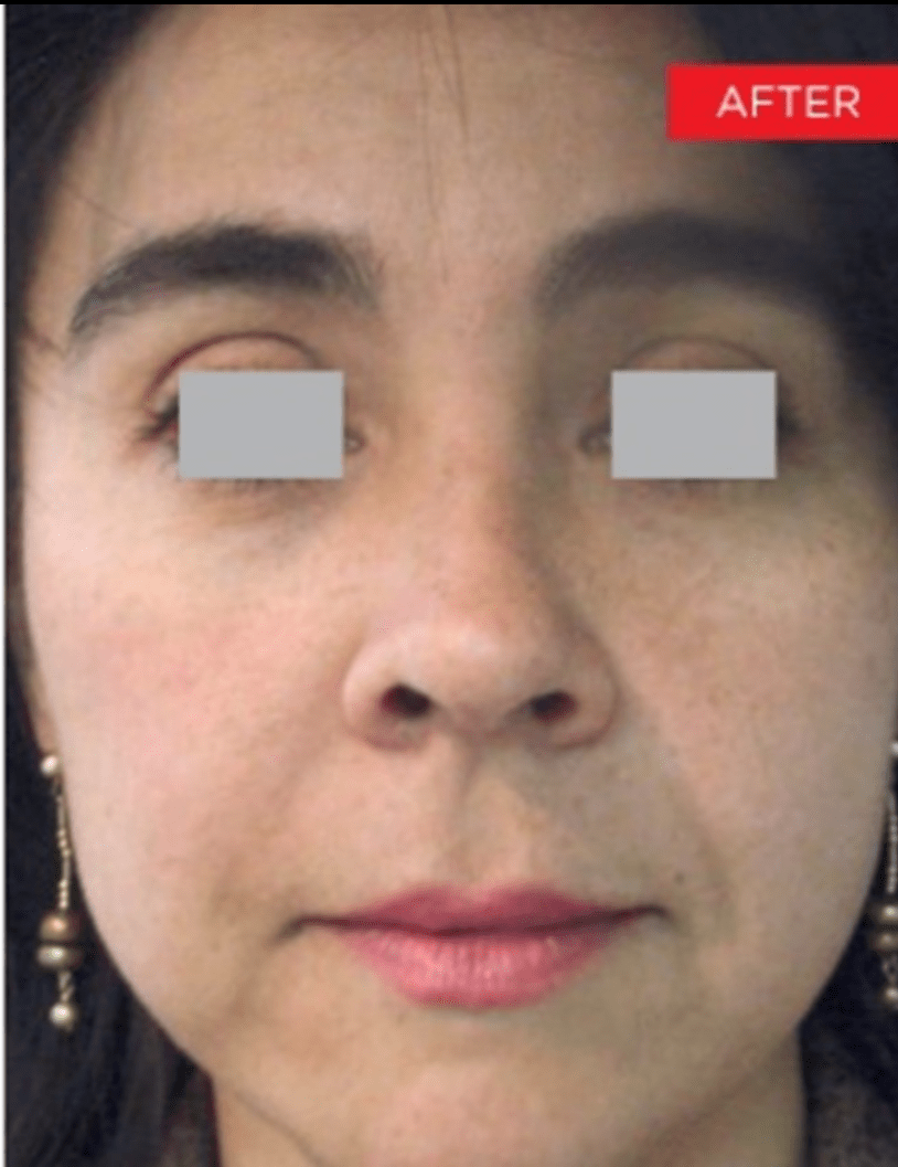 Fotona 4D NonSurgical Face Lift in Ottawa alchemistlaser