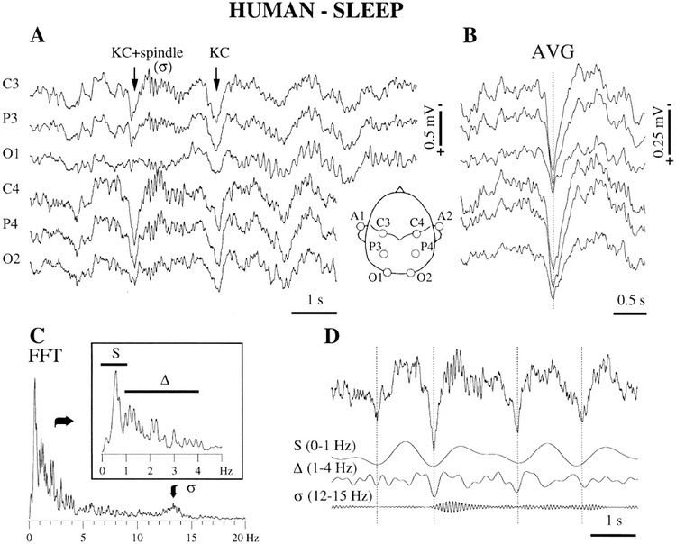 K complex Alchetron, The Free Social Encyclopedia