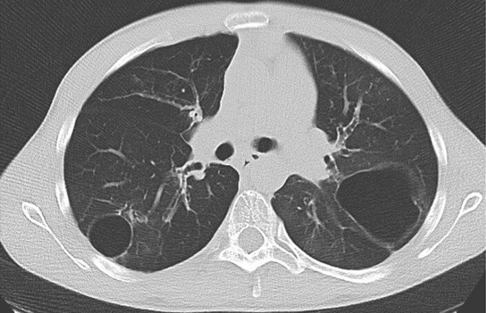 Pneumatoceles Dr. Javier Carbajal
