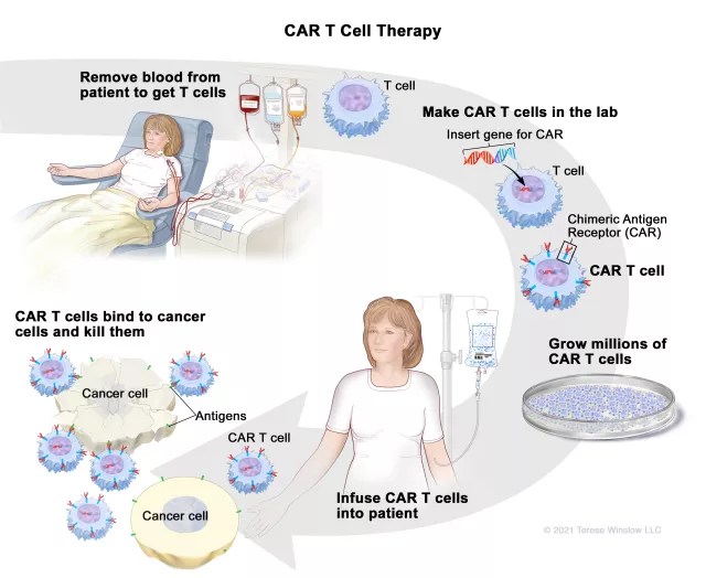 Revolutionizing Cancer Treatment Explaining CART Cell Therapy