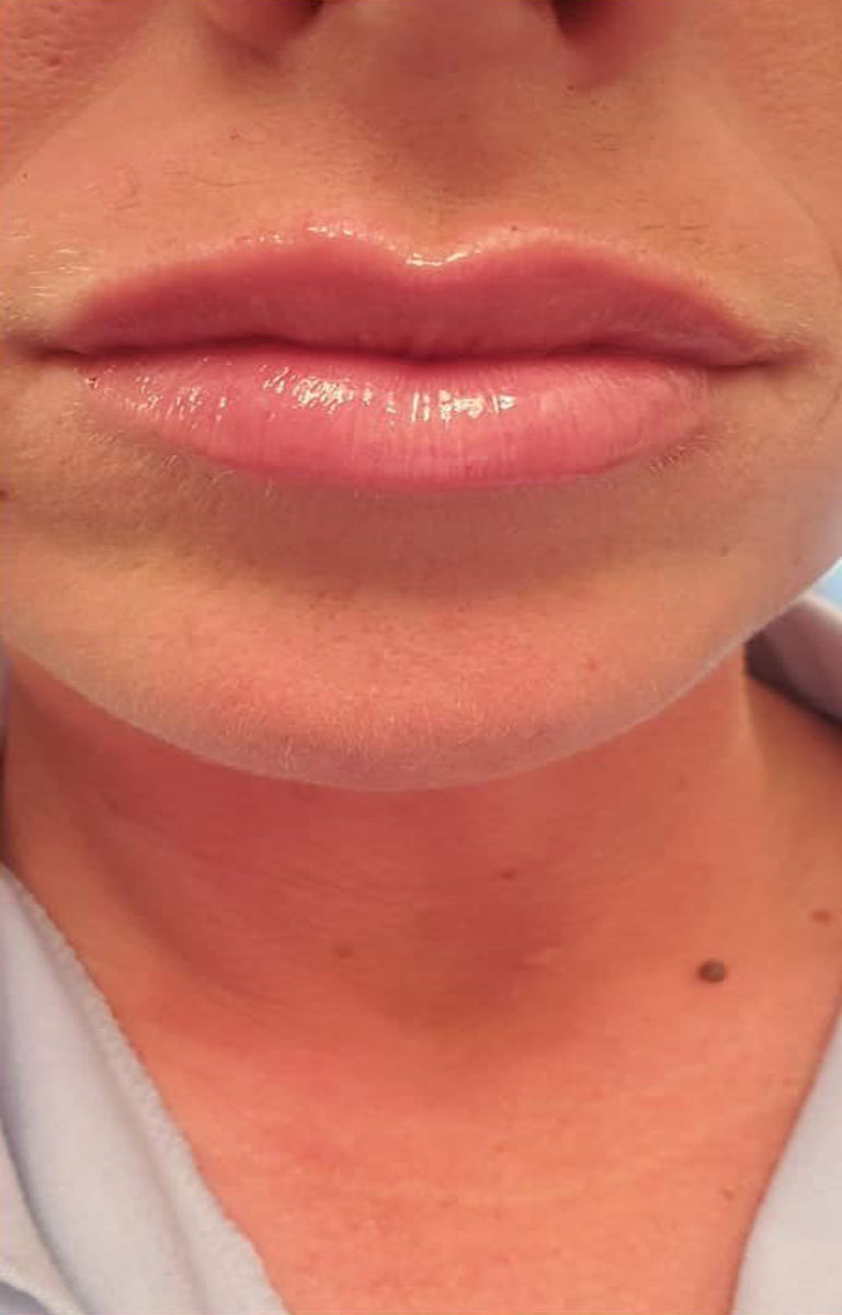 Cosmetic Injections Tulsa, OK Align Injectable Aesthetics