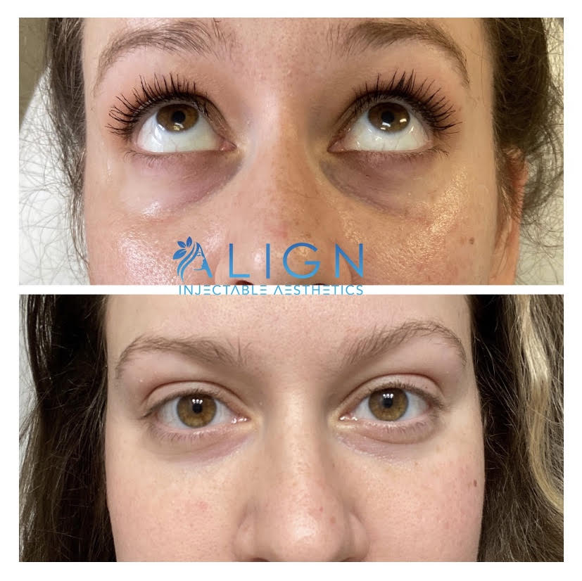 Injections For Dark Circles