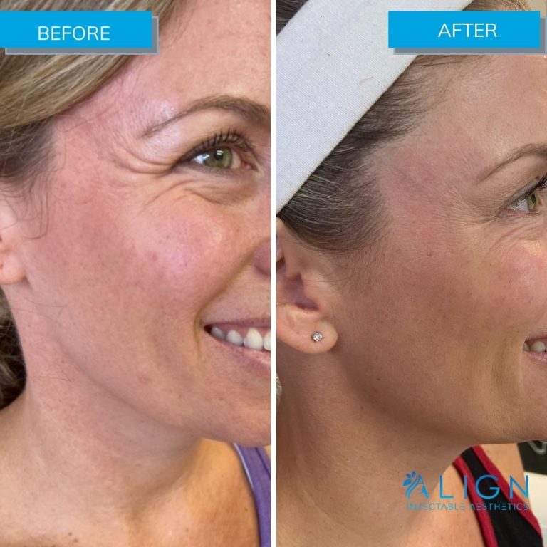 Before and After Botox® for Crow's Feet Align Injectable Aesthetics